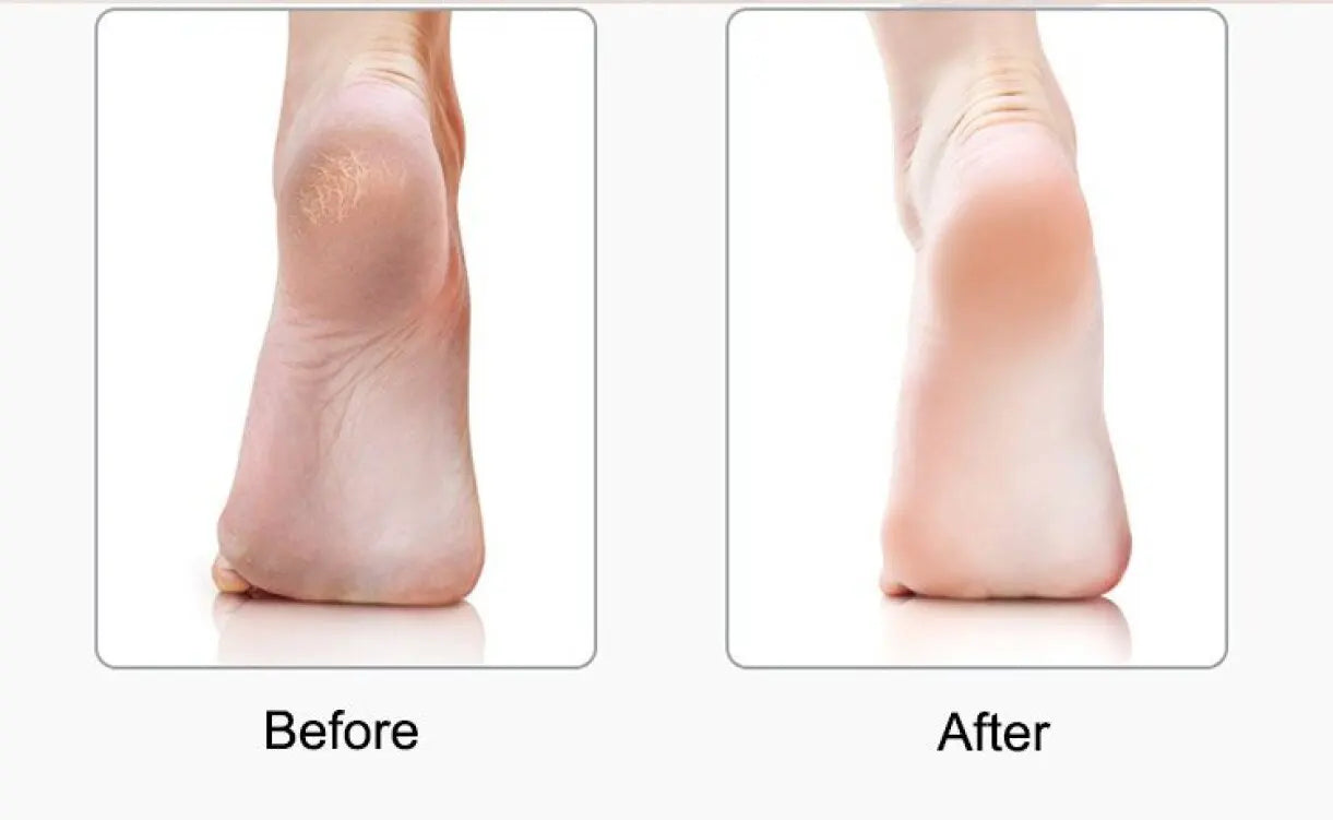 LunaWand™ Nuve Foot Care Magic
