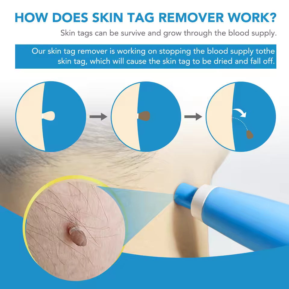 LunaSmooth™ Skin Tag Removal Kit