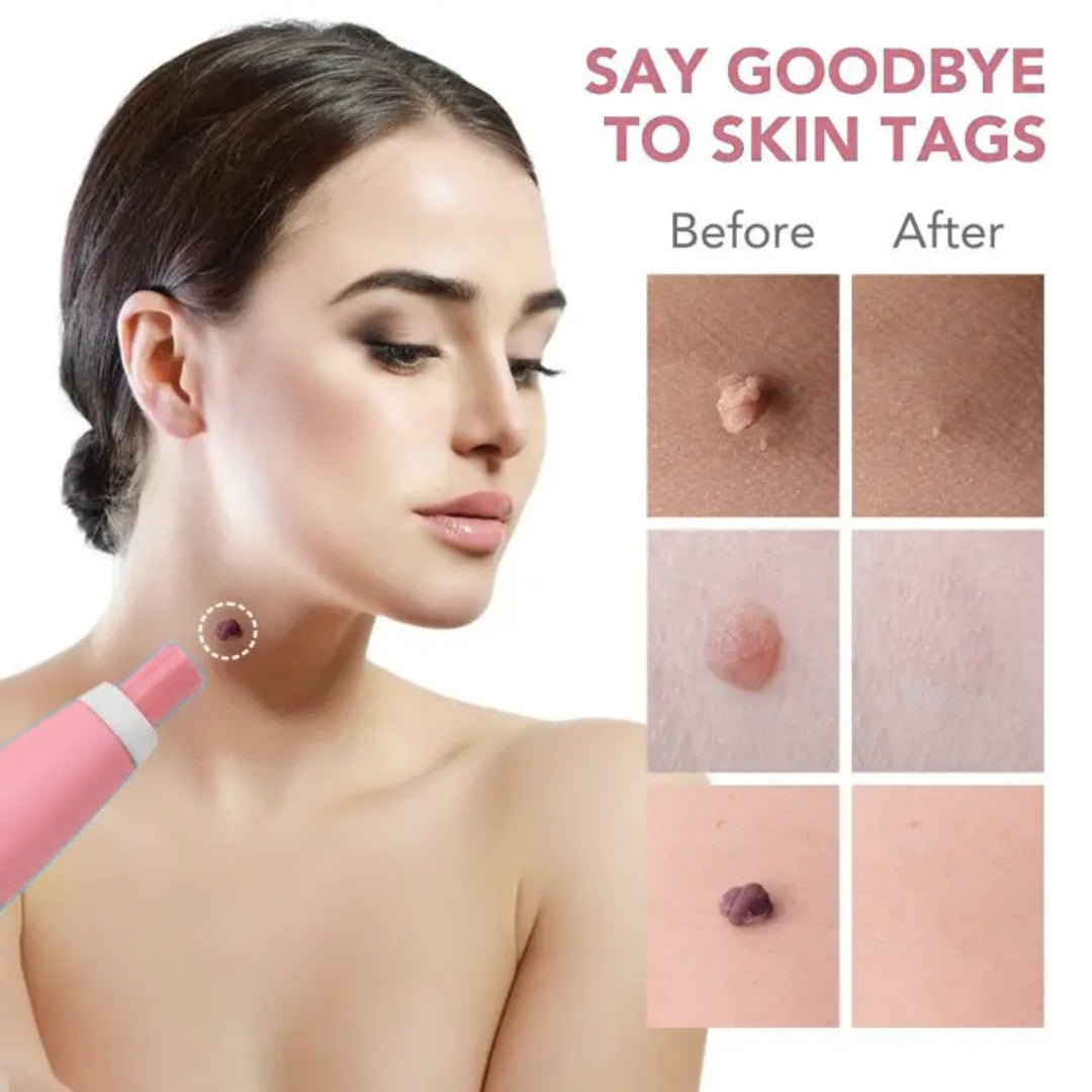 LunaSmooth™ Skin Tag Removal Kit