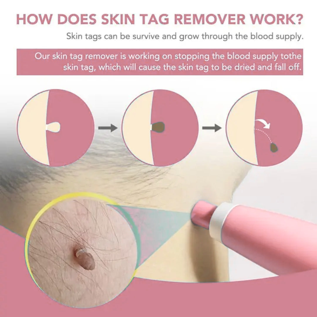 LunaSmooth™ Skin Tag Removal Kit
