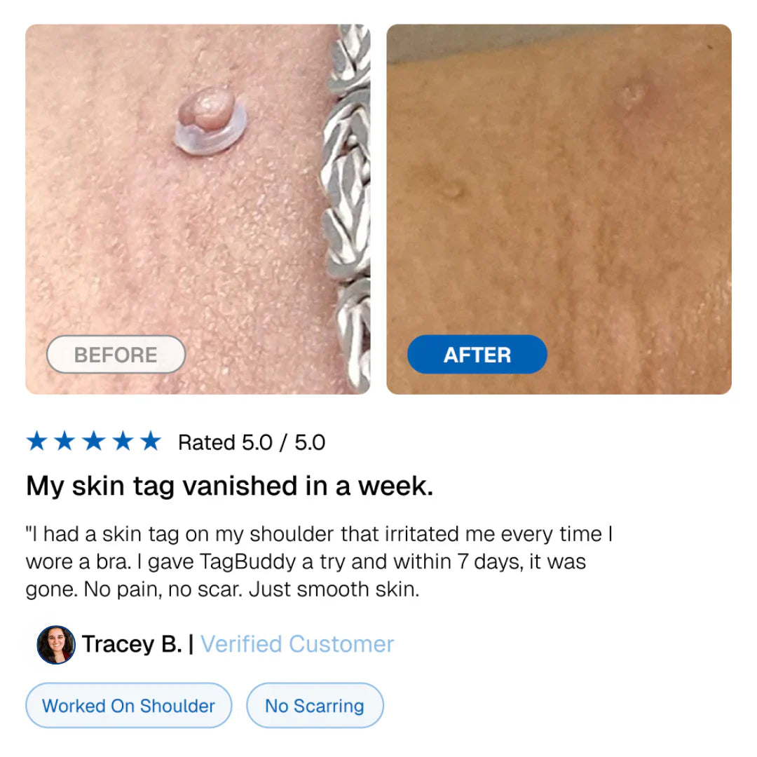 LunaSmooth™ Skin Tag Removal Kit