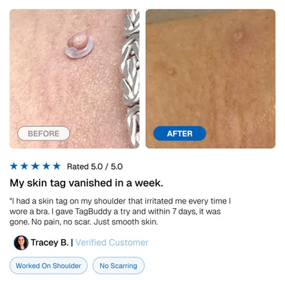 LunaSmooth™ Skin Tag Removal Kit
