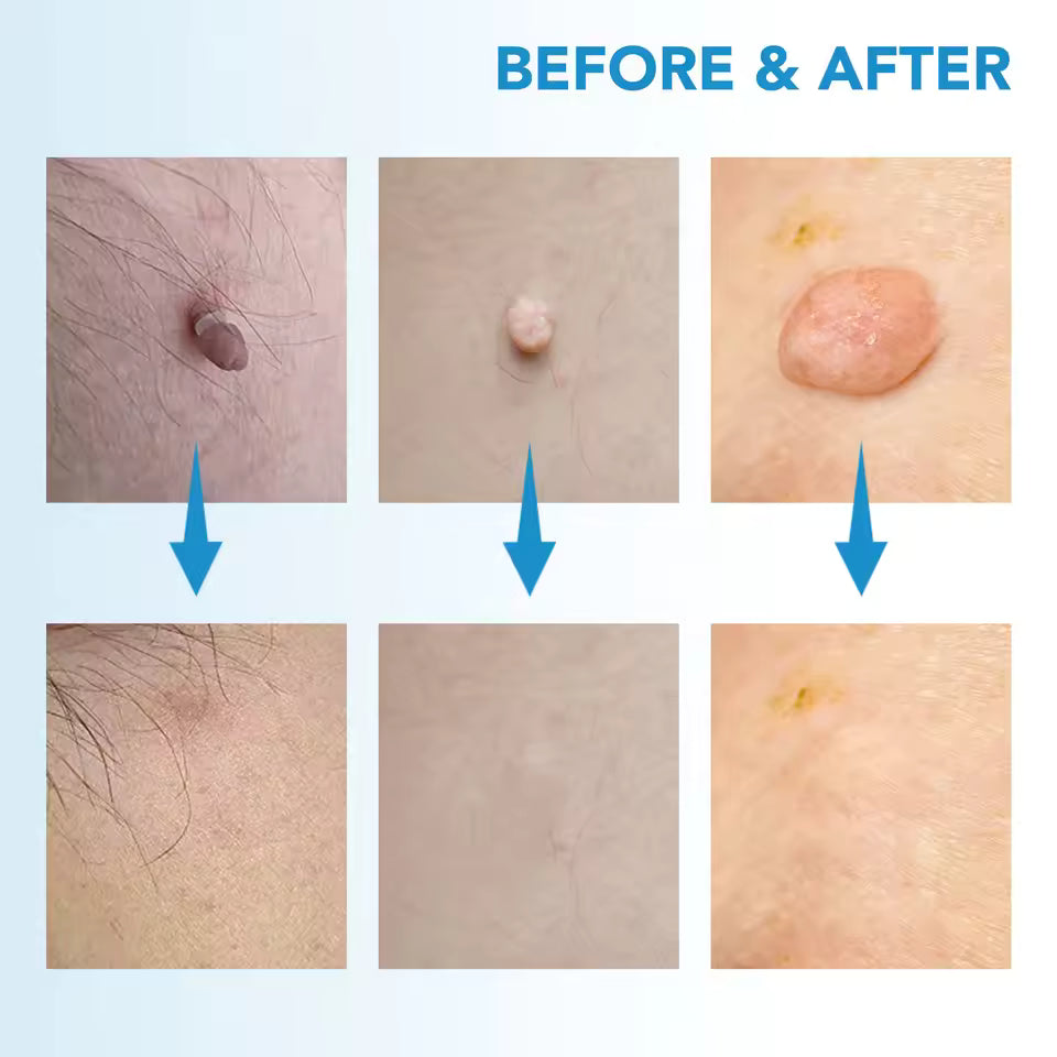 LunaSmooth™ Skin Tag Removal Kit
