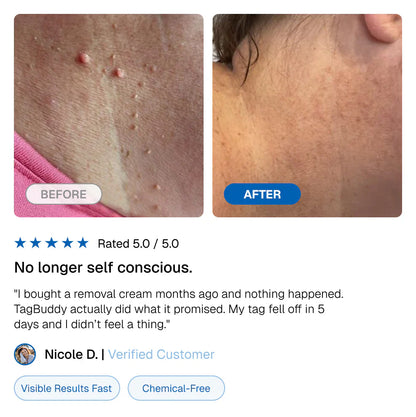 LunaSmooth™ Skin Tag Removal Kit